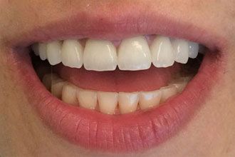 Blanchiment dentaire direct et indirect  